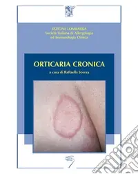 Nuovo Arrivo Orticaria cronica
